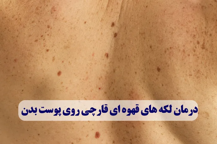 درمان لکه های قهوه ای قارچی روی پوست بدن