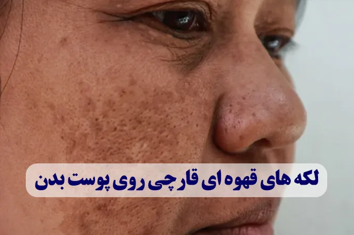 لکه های قهوه ای قارچی روی پوست بدن