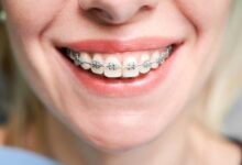 ارتودنسی شفاف ؛ نسل جدید اصلاح طرح لبخند در کلینیک دندانپزشکی شبانه‌روزی ارغوان کرج