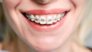 ارتودنسی شفاف ؛ نسل جدید اصلاح طرح لبخند در کلینیک دندانپزشکی شبانه‌روزی ارغوان کرج