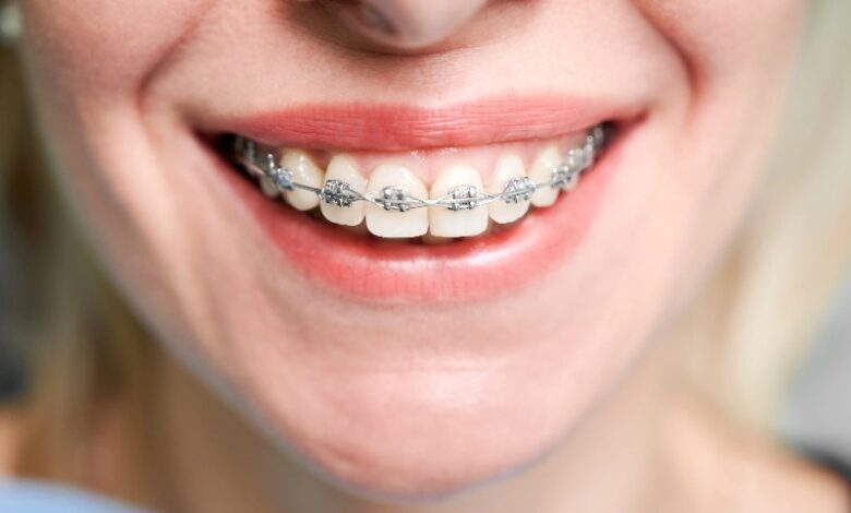 ارتودنسی شفاف ؛ نسل جدید اصلاح طرح لبخند در کلینیک دندانپزشکی شبانه‌روزی ارغوان کرج