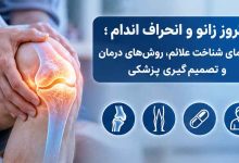 آرتروز زانو و انحراف اندام؛ راهنمای شناخت علائم