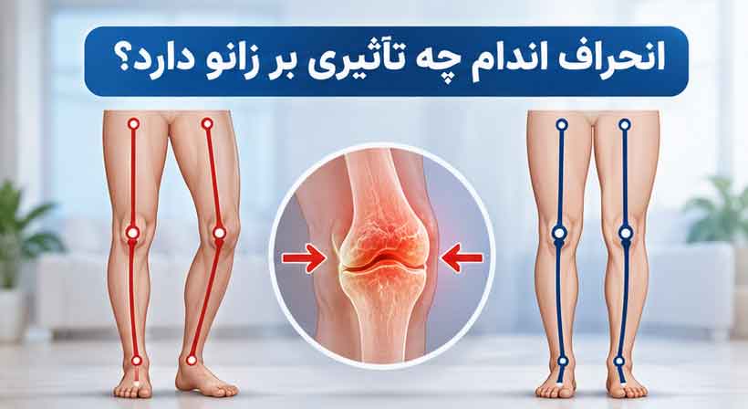 انحراف اندام چه تأثیری بر زانو دارد؟