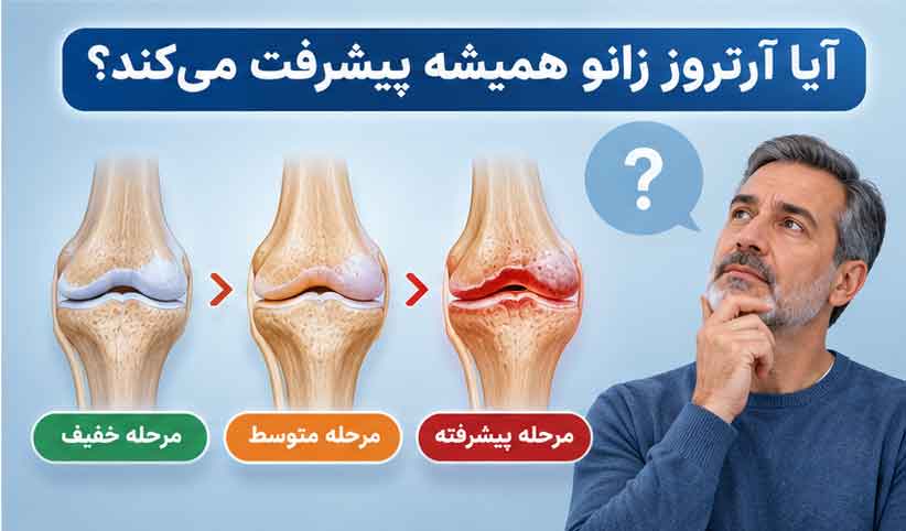 آیا آرتروز زانو همیشه پیشرفت می‌کند؟